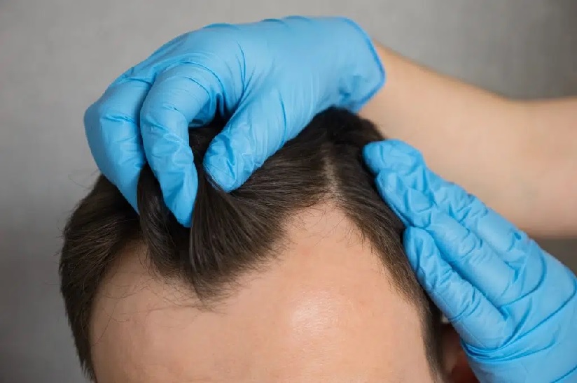 Male Hair Loss Treatments in Singapore